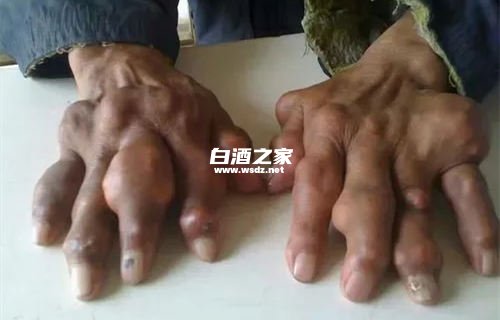 尿酸505可以喝白酒吗  2