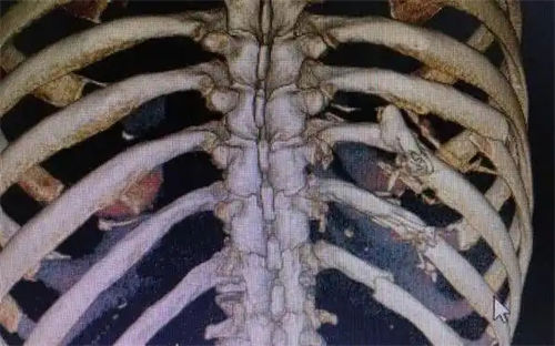 肋骨断裂治疗期间能喝白酒吗  1