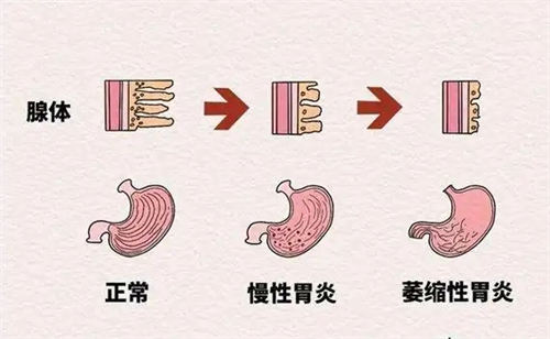 吃螃蟹喝白酒会导致胃病吗  2