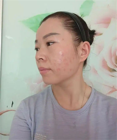 塑料瓶装白酒会喝出过敏体质吗？  2