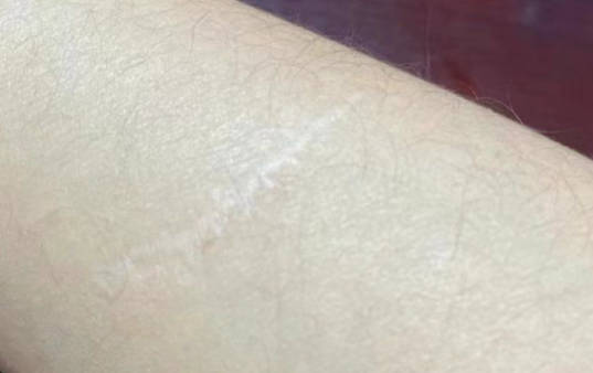 疤痕可以涂抹人久久白酒吗？为何不建议你这么做？