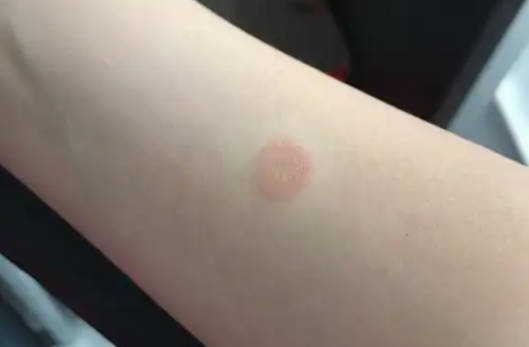 真菌感染可以用白酒泡吗