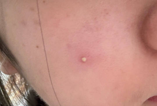 长痘痘能喝白酒吗，有痘痘该怎么正确处理？